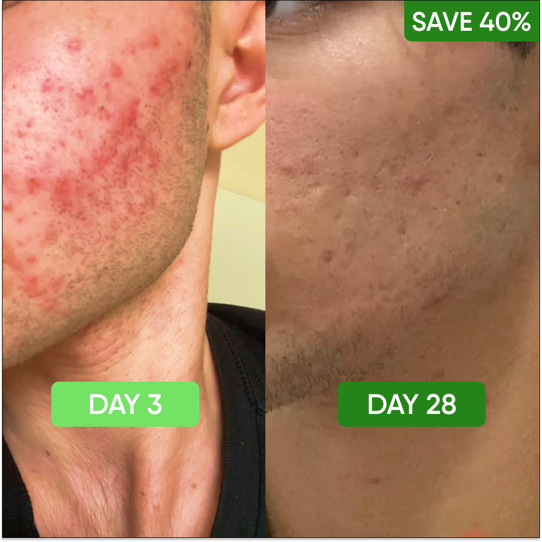 Acne Care Kit
