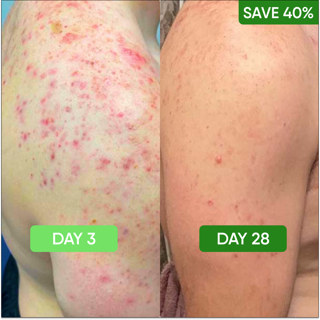 Body Acne Care Kit