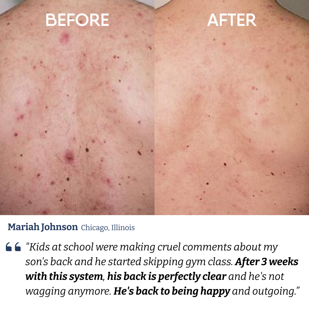 Body Acne Care Kit
